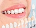 牙齿贴片可定制牙齿全瓷贴片国产铸瓷仿真贴片 4
