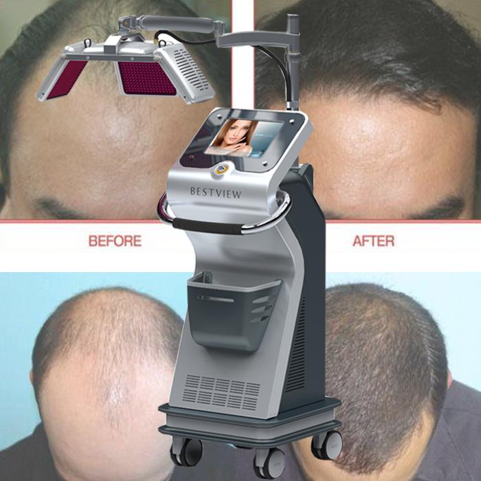 670nm Wavelengths Hair Loss Treatment Machine Hair Regrowth Laser