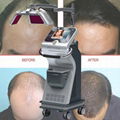 670nm Wavelengths Hair Loss Treatment