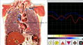 Metatron Hunter NLS System  4025  Bioresonance Health Scan and Therapy