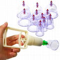 Cupping Therapy