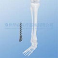 Distal Lateral Fibular LOC Plate--Orthopedic implants, Pure titanium, LOC