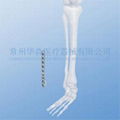 Distal Lateral Fibular Plate--Fixation, Orthopedic implants,Trauma, LCP, Placa 2