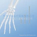 1.0mm Mini Metacarpal Plates--Fixation, Pure titanium, Trauma, Mini, Placa