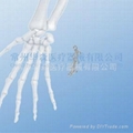 1.0mm Mini Metacarpal Plates--Fixation, Pure titanium, Trauma, Mini, Placa