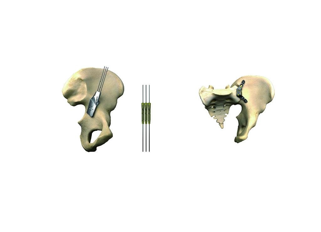 DS 蝶形骶髂骨锁定接骨板--骨科植入物、纯钛、LOC、创伤 3