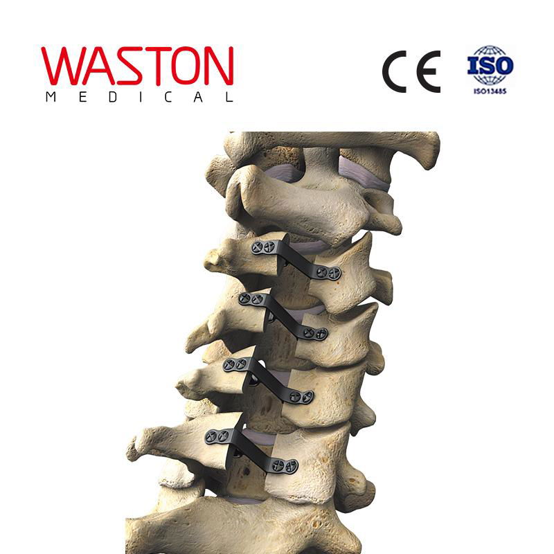 NEULEN cervical laminoplasty system--Orthopedic, Minimally invasive, Spinal