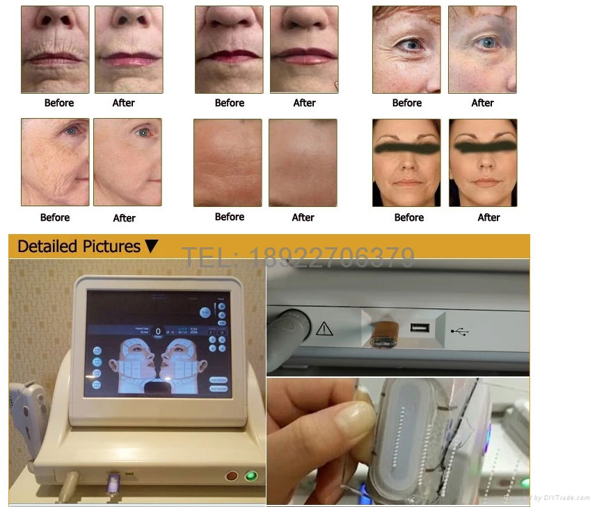 2016 hifu skin lifting beauty ultrasonic knife ultrasound face lift machine 5