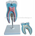 P-1385 Anatomical model of molar tooth with caries  1