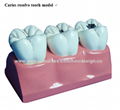 P-1384 Caries resolve tooth model 1