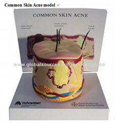 P-1371 Common Skin Acne model 