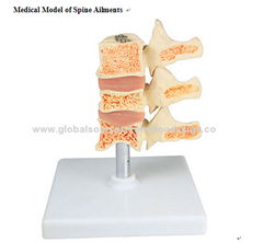 P-1303 Medical Model of Spine Ailments 
