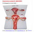 P-1163 Diseased ovary/uterus model  2