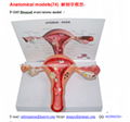 P-1163 Diseased ovary/uterus model 
