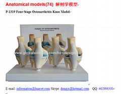 P-1319 Four-Stage Osteoarthritis Knee Model