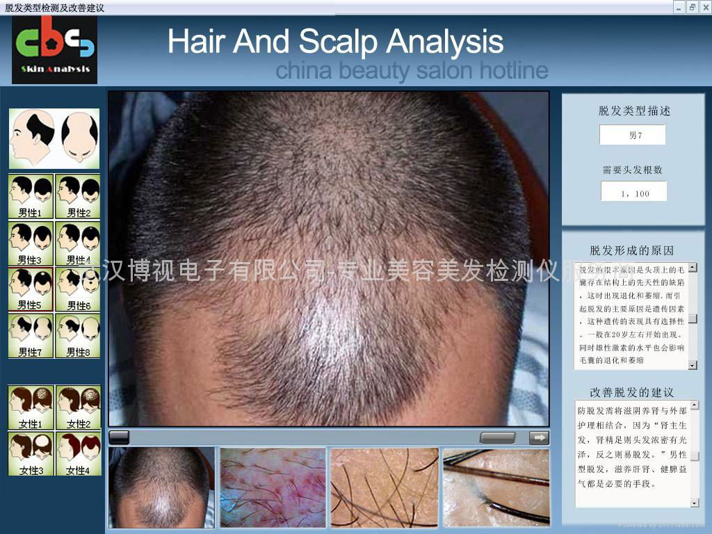 Scalp Camera（For hair transplanting ） 4