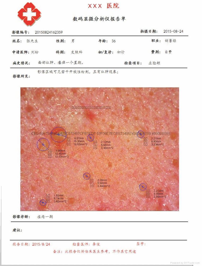 电子皮肤镜（皮肤病高配版） 2