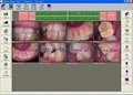 200 million pixels SONY CCD VGA + USB intraoral camera 5
