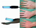 Psoriasis Treatment Hand-held Lamps