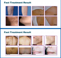 Elos Hair Removal Diode Laser 808nm Beauty Machine for Permanent Hair Remover 5