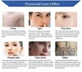 Laser Pen Light Therapy melasma skin toning removal picolaser esthetic salon